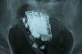 Sri Lanka: un détenu trahi par la sonnerie du portable dissimulé dans son corps
